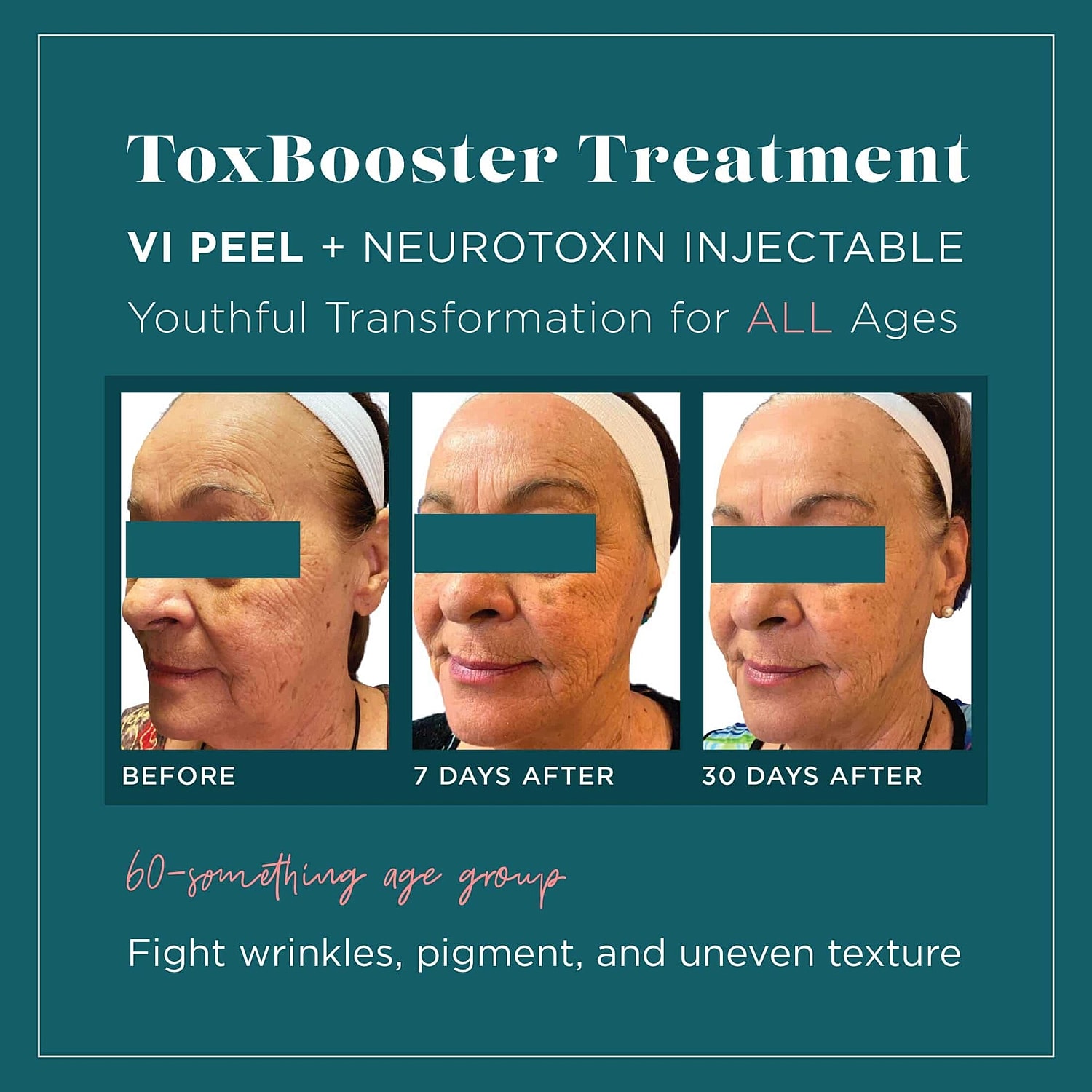 Introducing TOXBOOSTER: the Ultimate Mash-up of VI Peel & Neurotoxin Injections