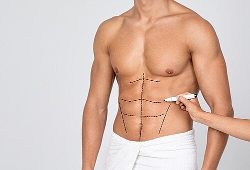Will I Need a Tummy Tuck After Liposuction?
