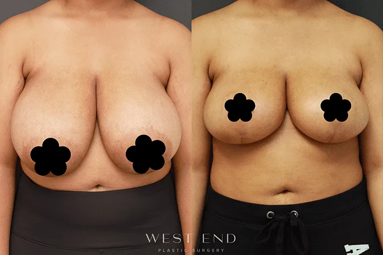 Before & After Image of Breast Reduction Washington DC
