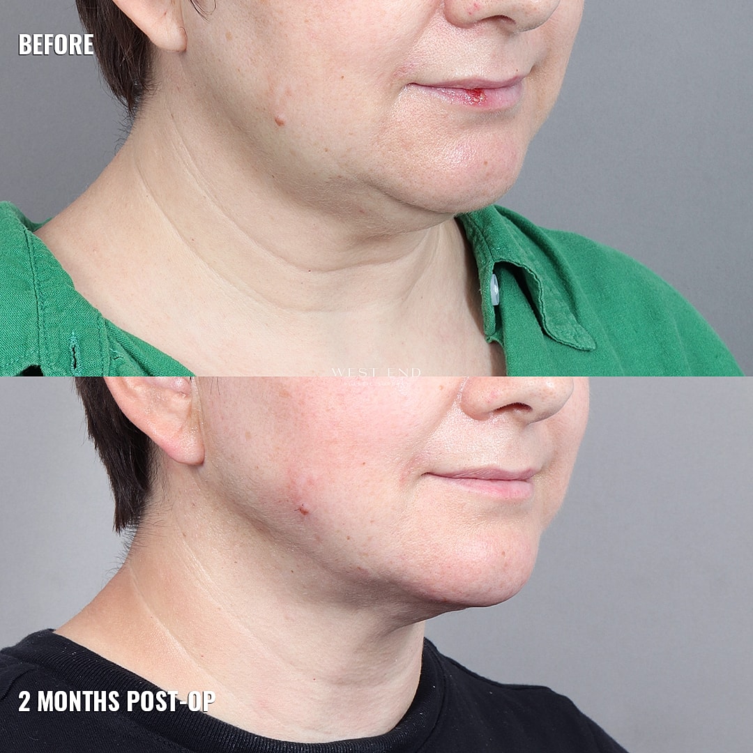 Before and after cosmetic procedure results comparison.