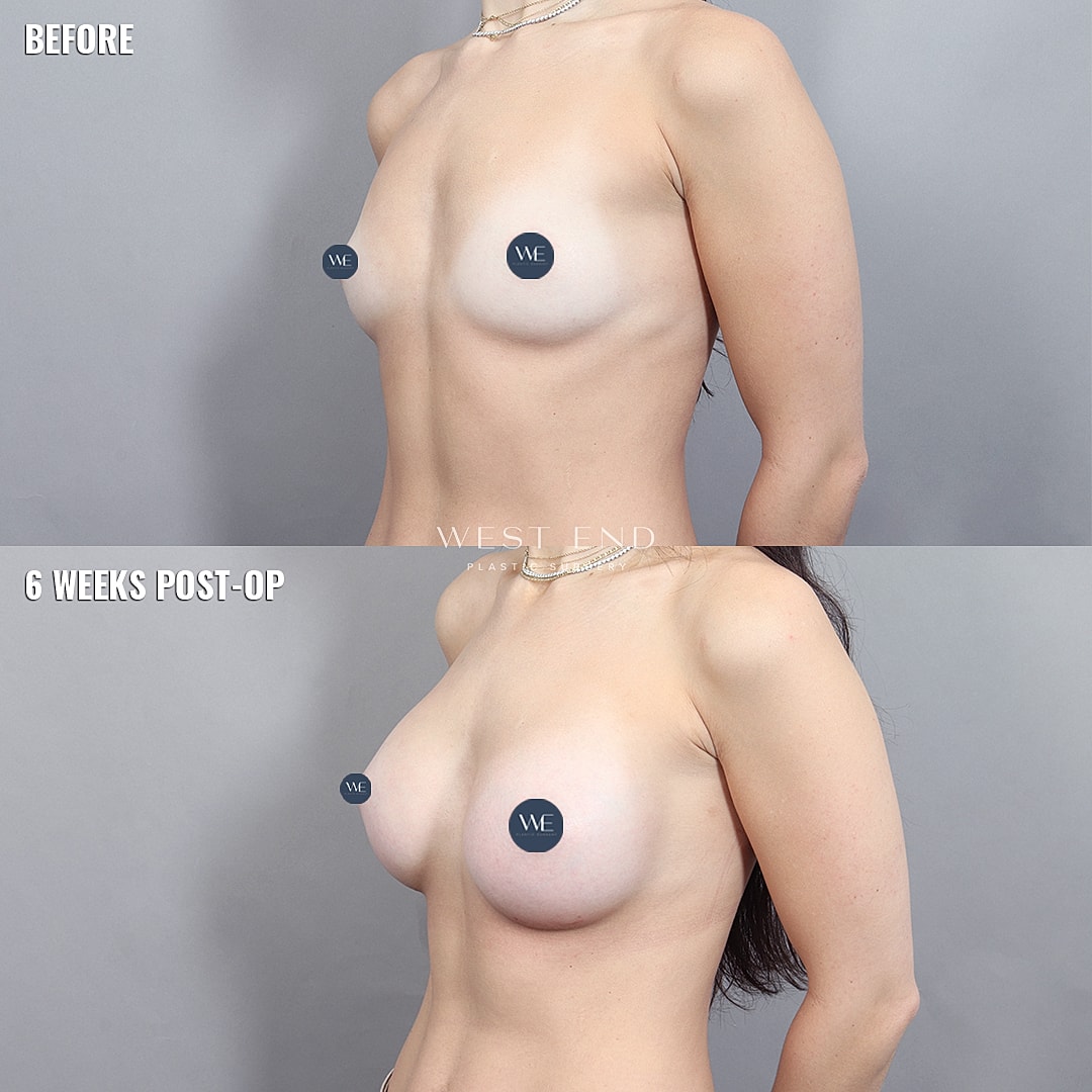 Before and after breast augmentation images comparison