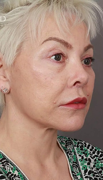 Female profile with short, bleached hair.