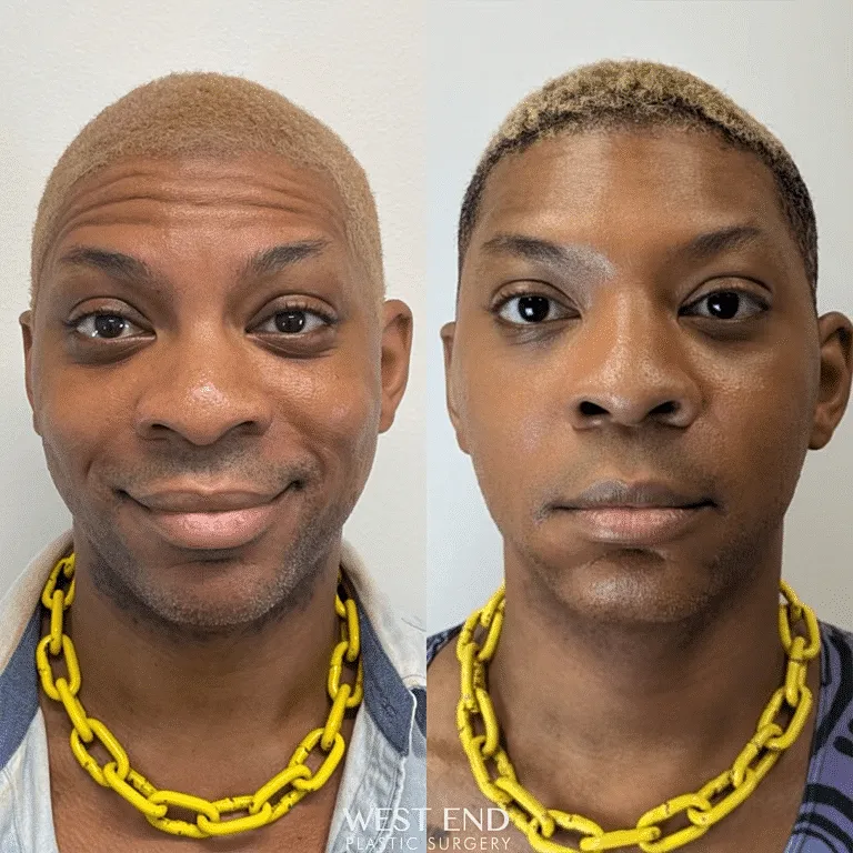 before and after dysport treatment Washington DC
