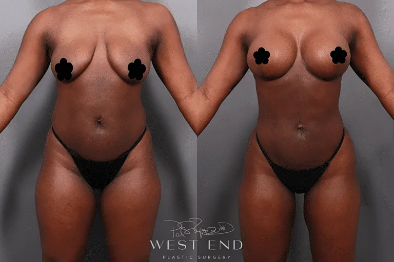 Before and after body transformation photos