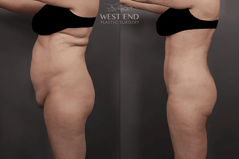 Side view before and after body contouring.