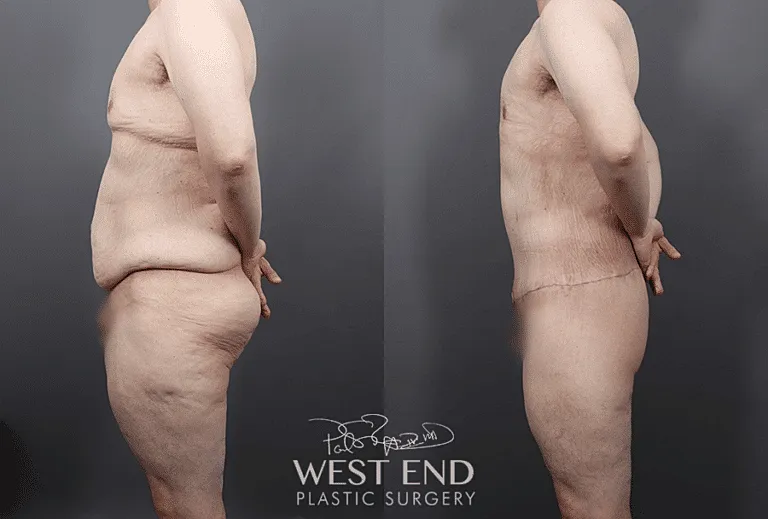 Before and after plastic surgery side views