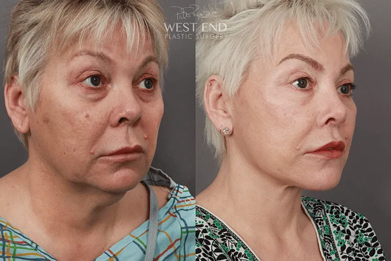 Before and after plastic surgery transformation.