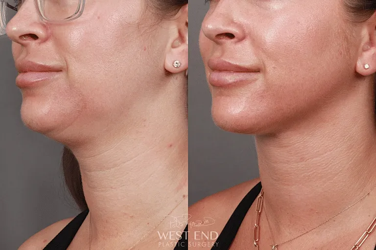 Before and after facial contouring comparison.