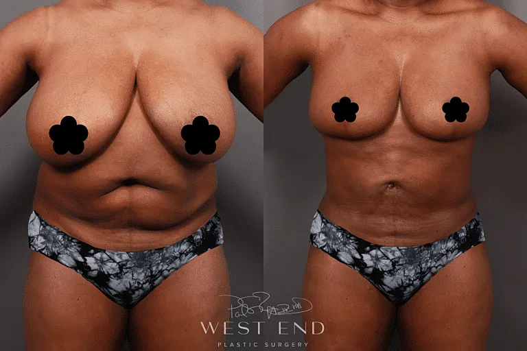 Before and after plastic surgery transformation.