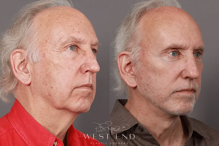 Before and after profile of male facelift.