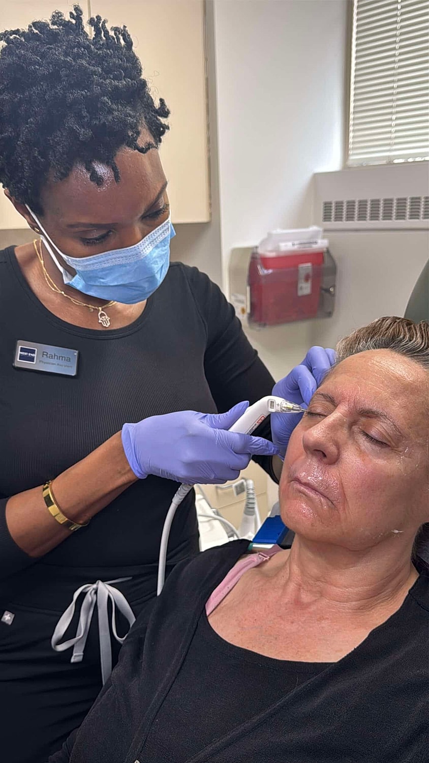 Exact RF Microneedling in Washington, DC