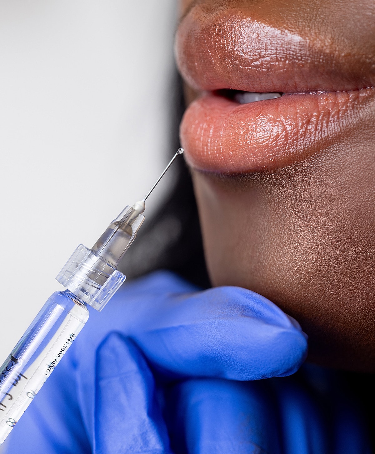 Injection near lips for cosmetic treatment.