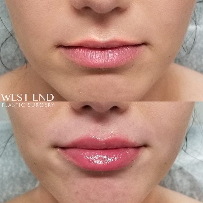 Before and After Image of Lip Augmentation with JUVÉDERM® Washington DC