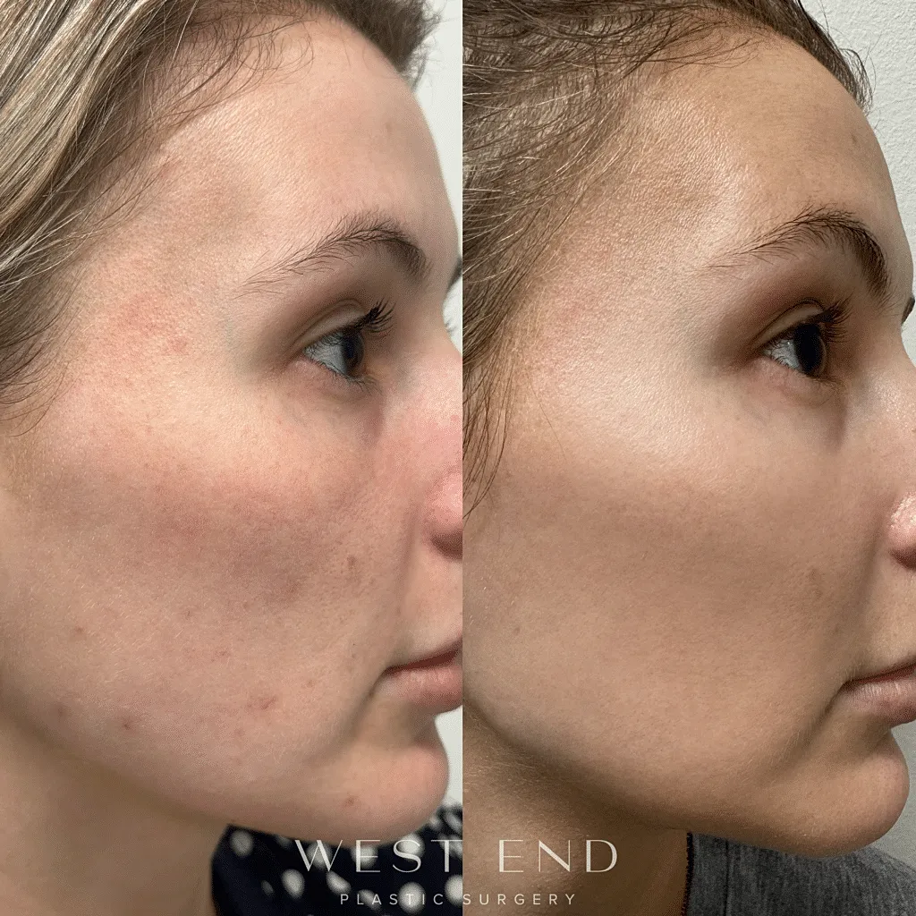 Before and After Image of Laser Genesis Washington DC