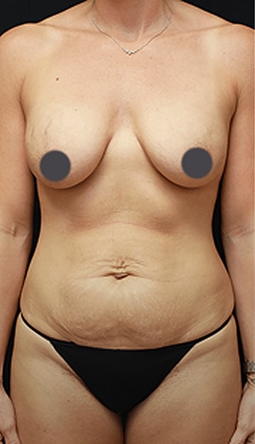 Before and after body image comparison.