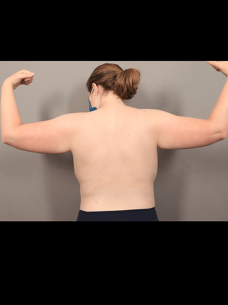 Renuvion Before & After