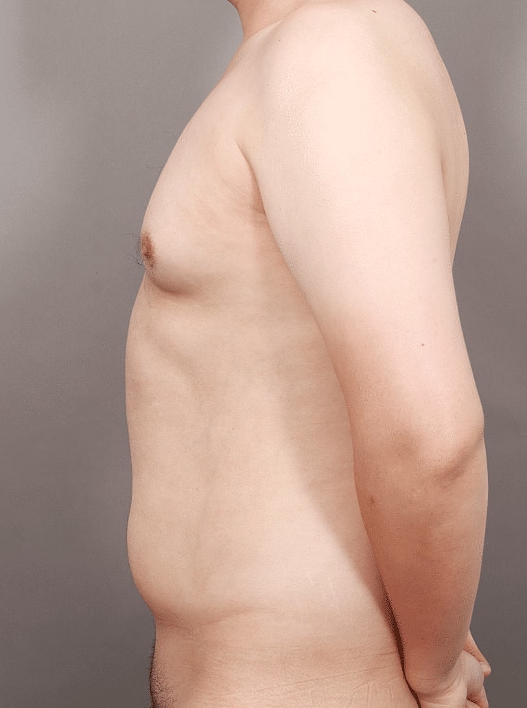 Renuvion Before & After