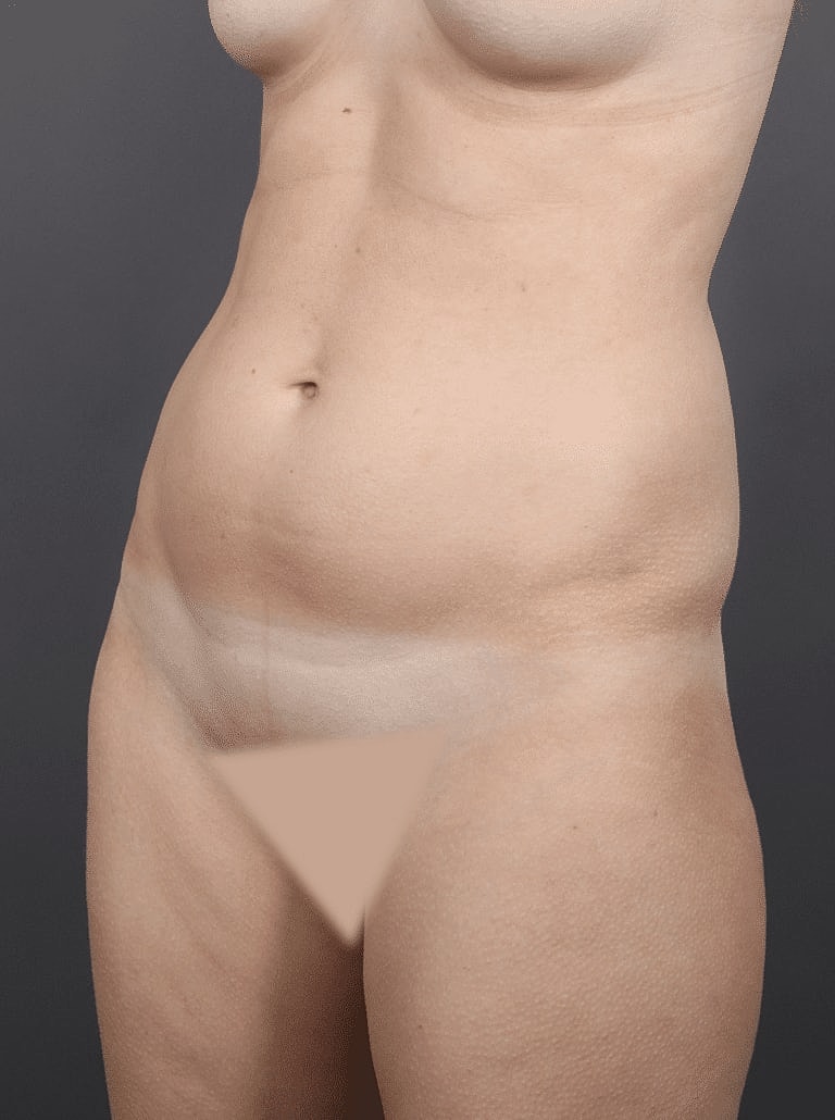 Renuvion Before & After