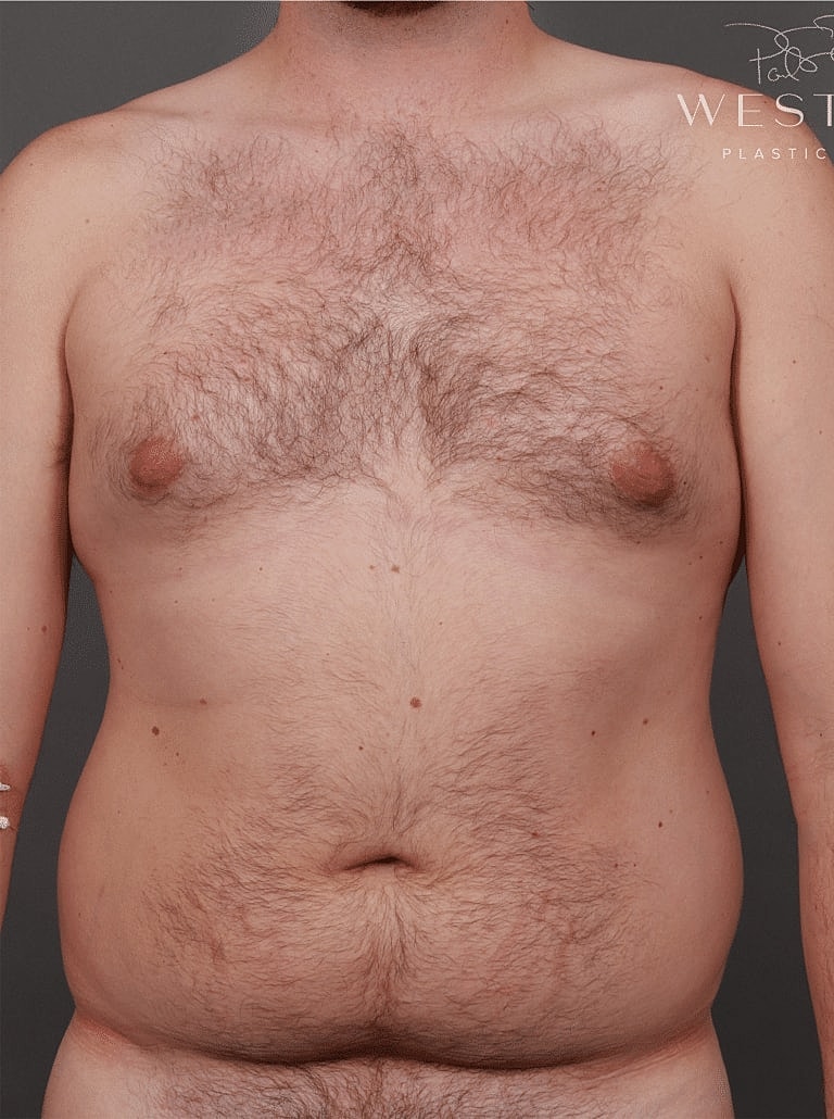 Renuvion Before & After