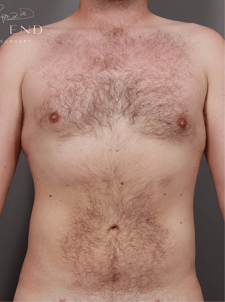 Renuvion Before & After