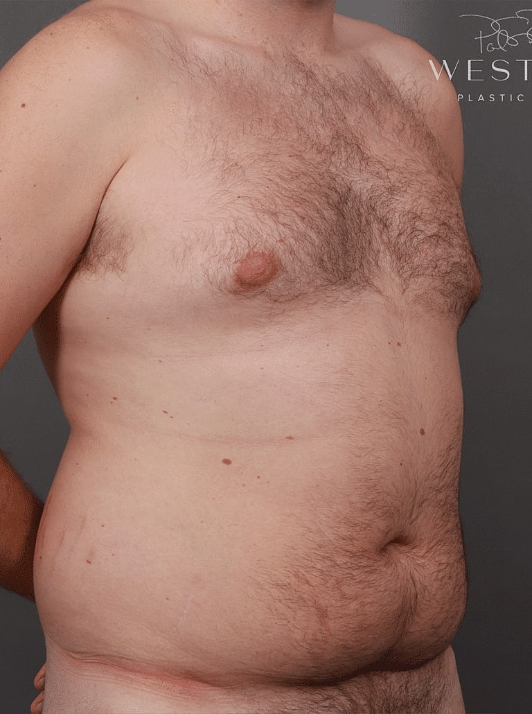 Renuvion Before & After