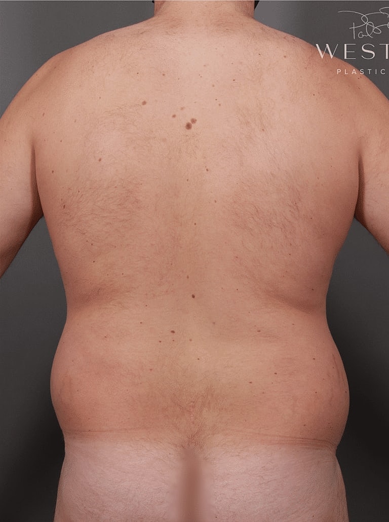 Renuvion Before & After