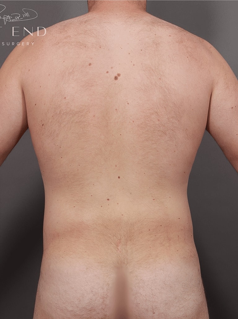 Renuvion Before & After