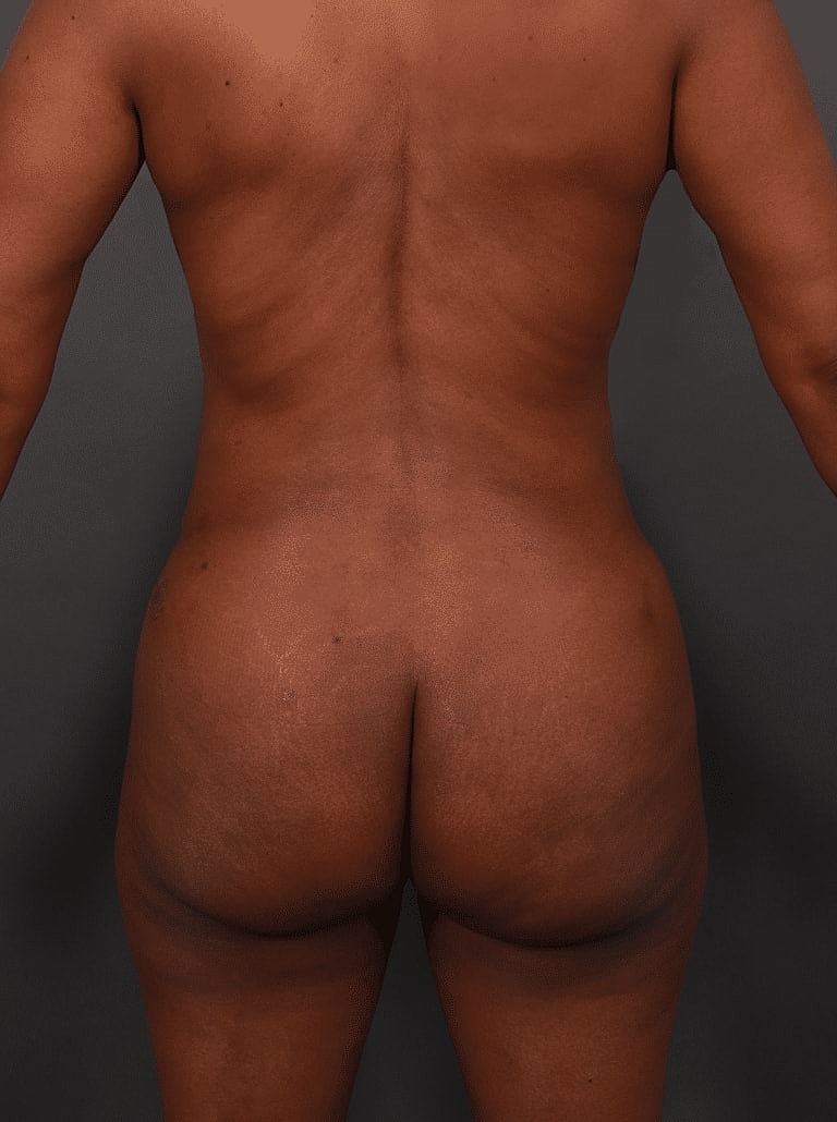 Renuvion Before & After