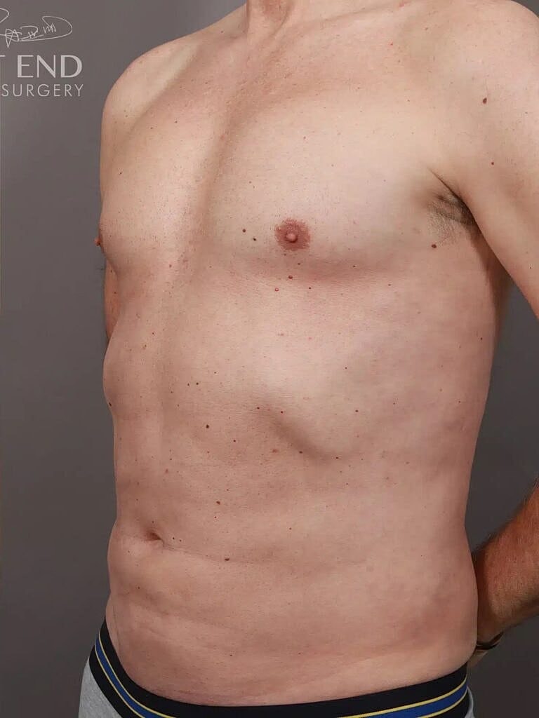 Renuvion Before & After