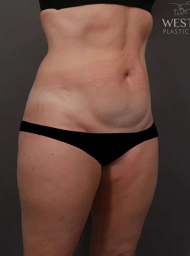 Renuvion Before & After