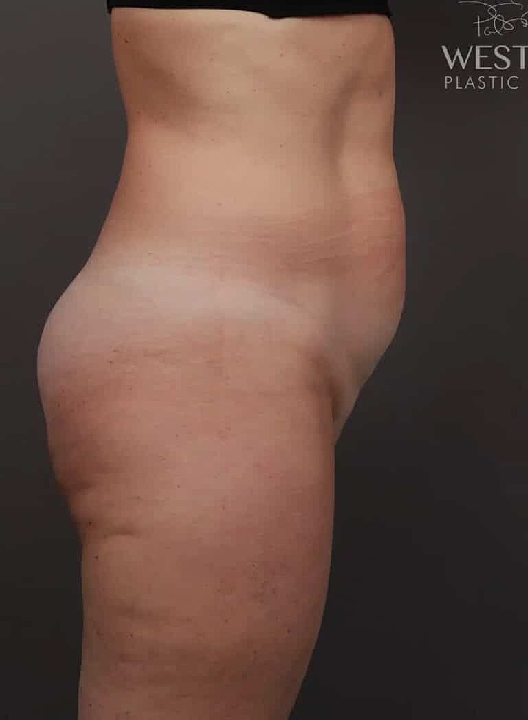 Renuvion Before & After