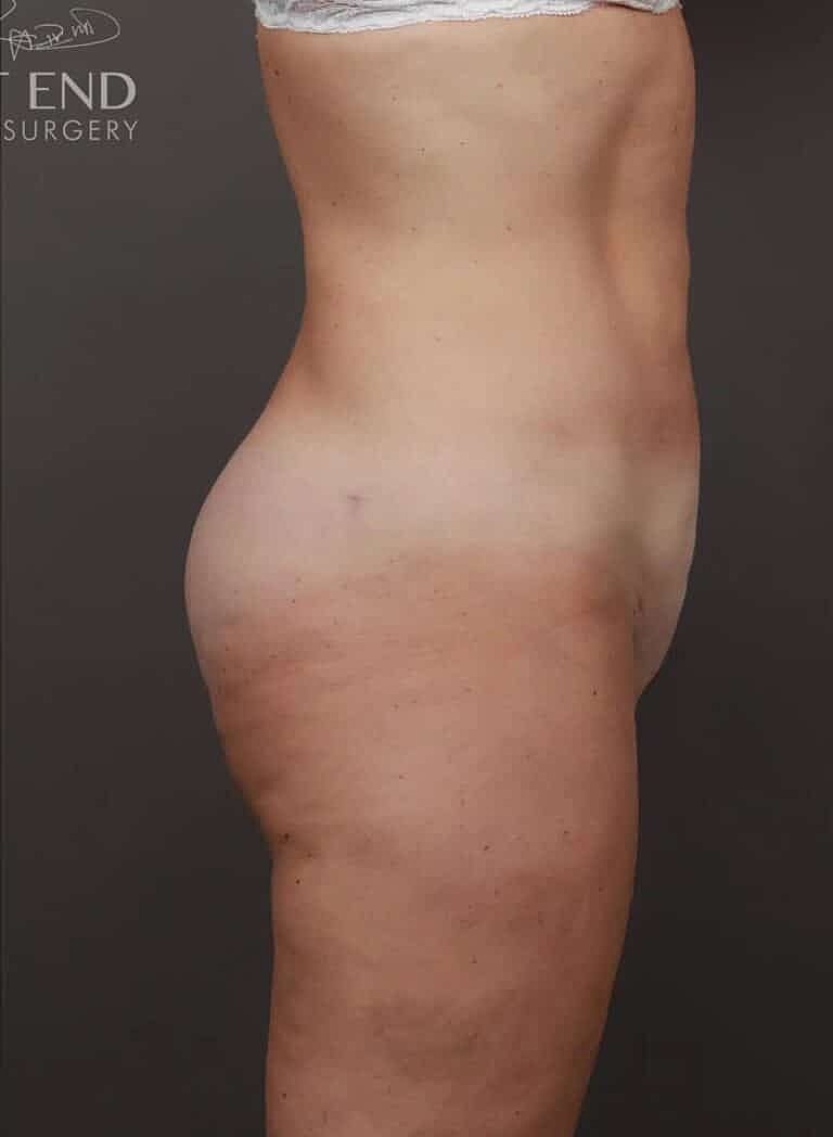 Renuvion Before & After