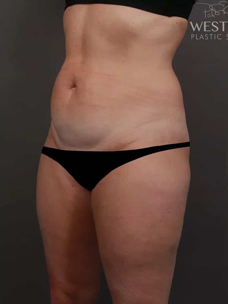 Renuvion Before & After