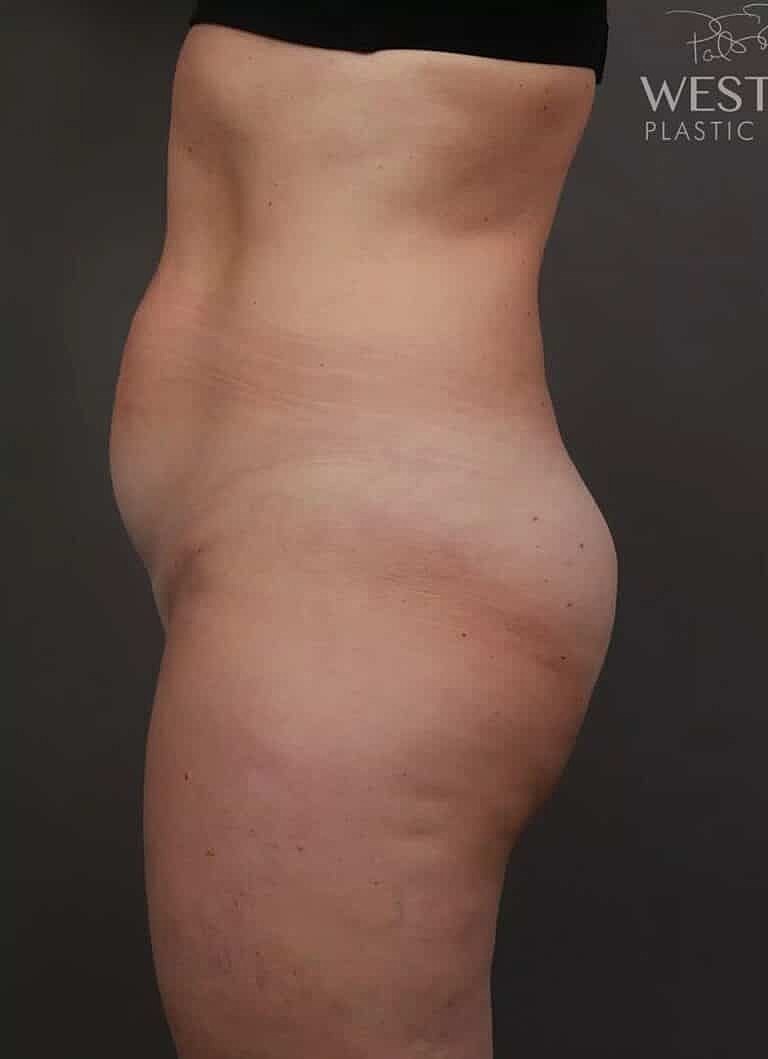 Renuvion Before & After