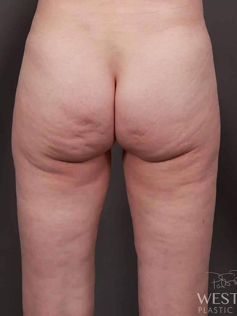 Renuvion Before & After