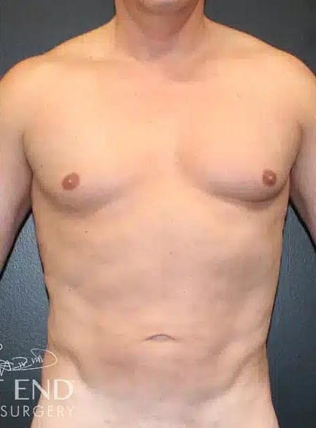 Renuvion Before & After