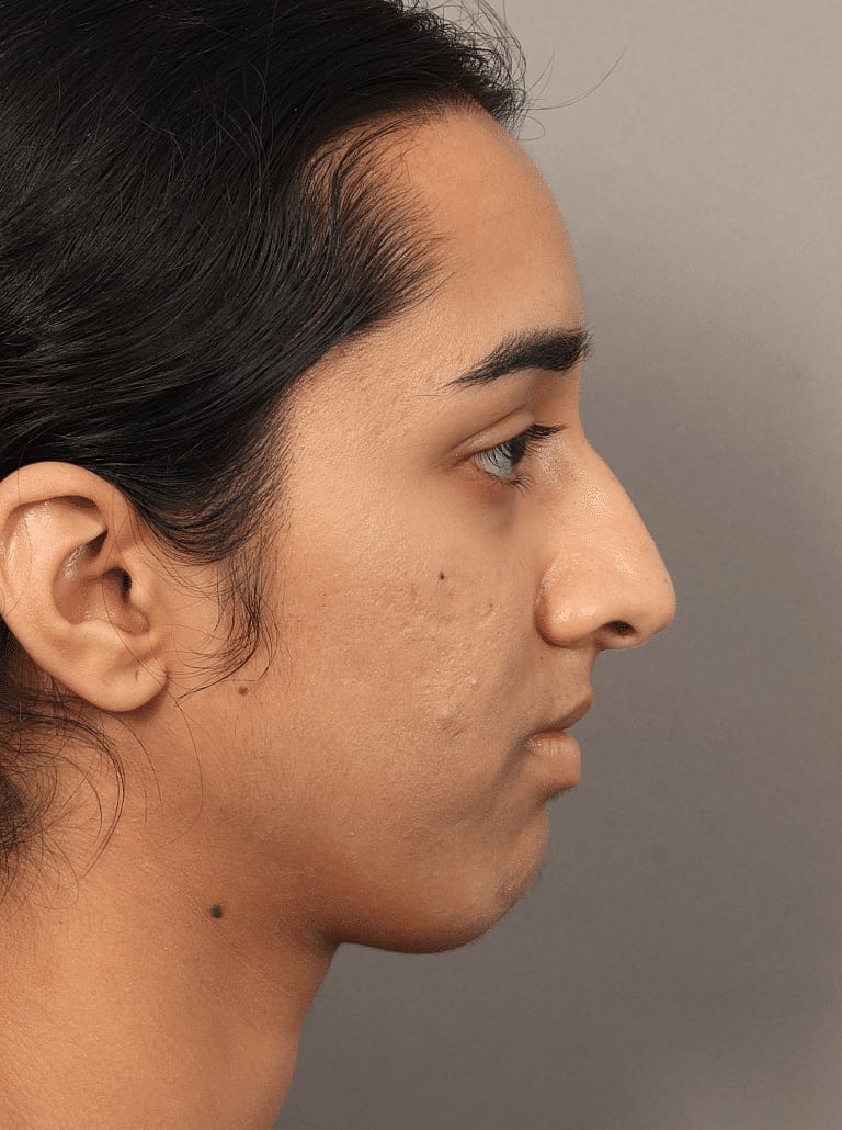 Alarplasty Nostril Reduction Before & After