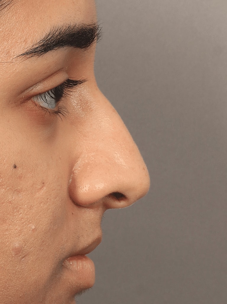 Alarplasty Nostril Reduction Before & After