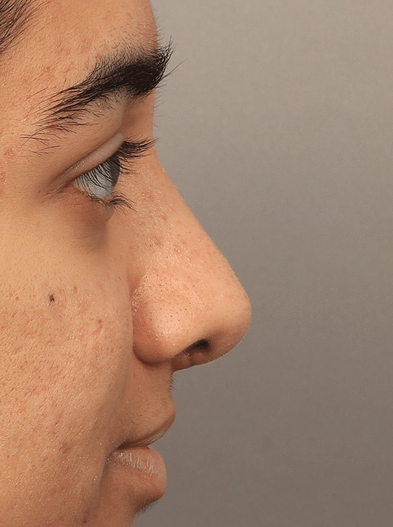 Alarplasty Nostril Reduction Before & After