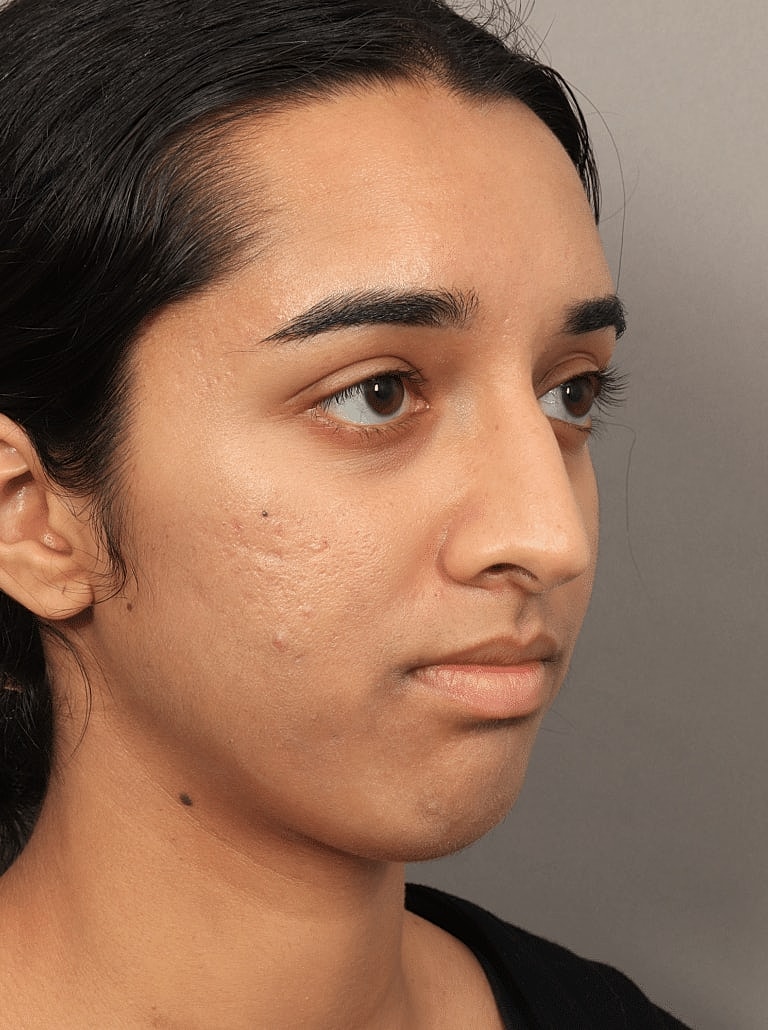 Alarplasty Nostril Reduction Before & After