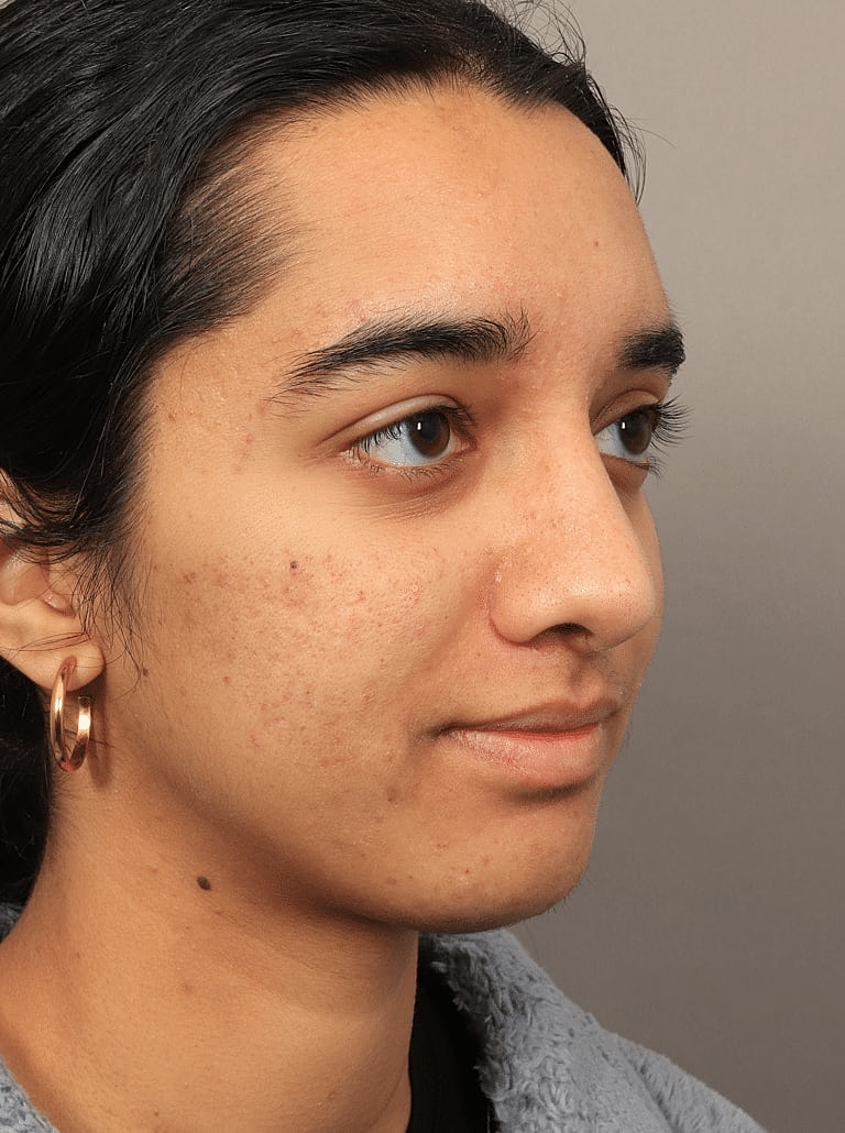 Alarplasty Nostril Reduction Before & After