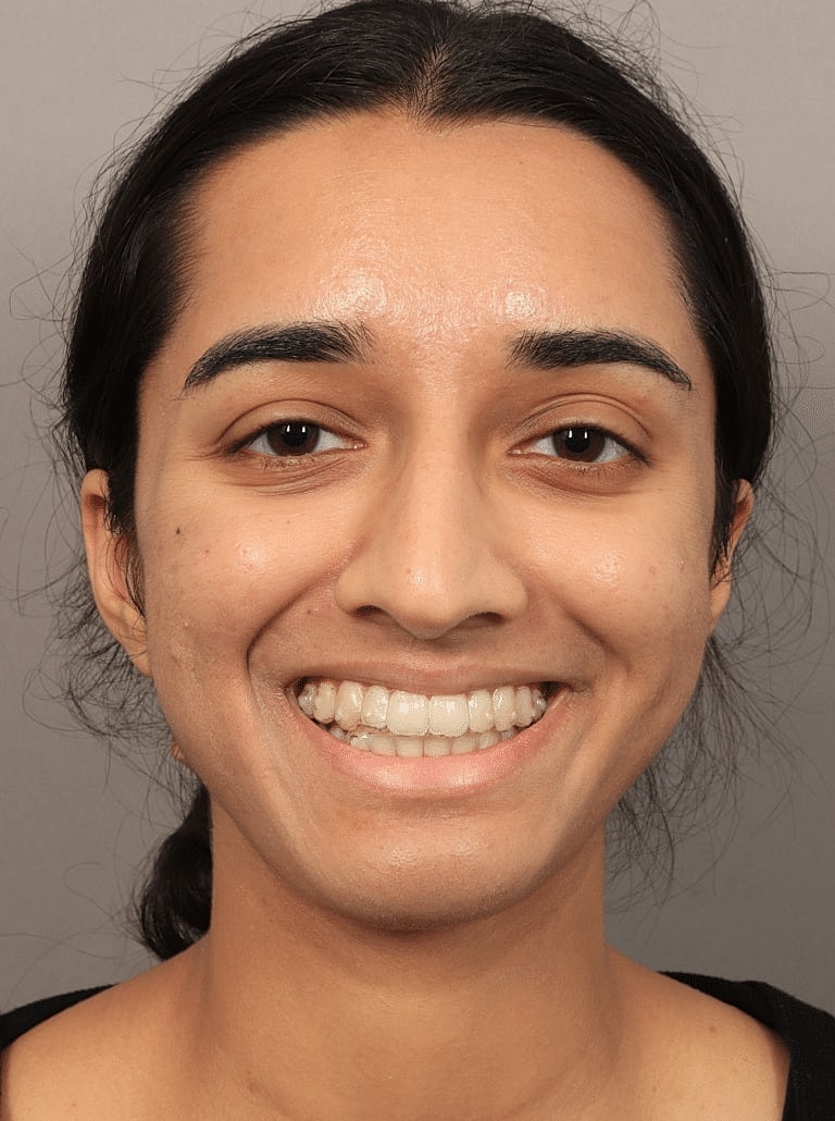 Alarplasty Nostril Reduction Before & After