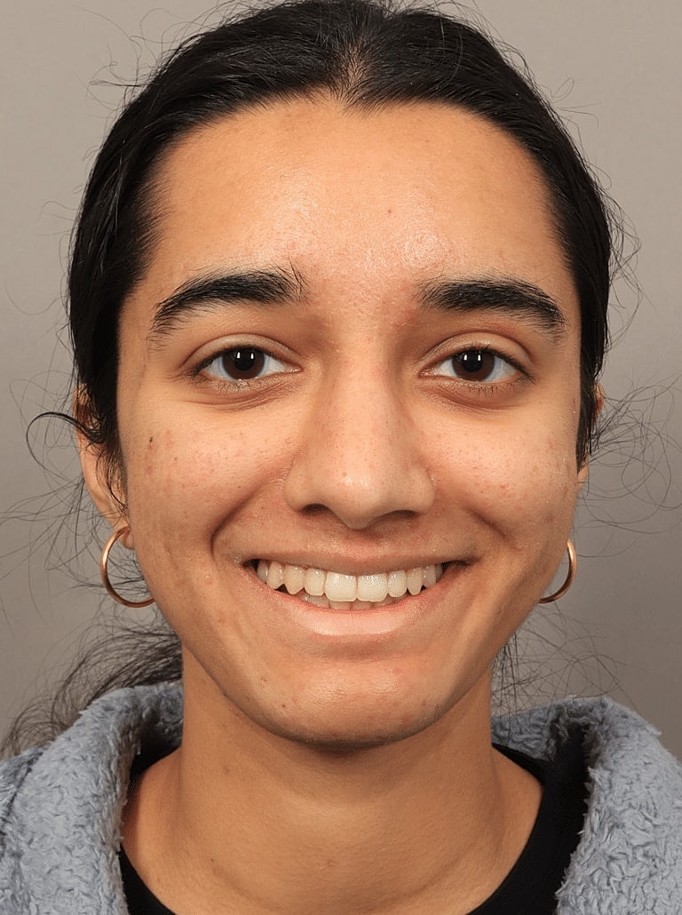 Alarplasty Nostril Reduction Before & After