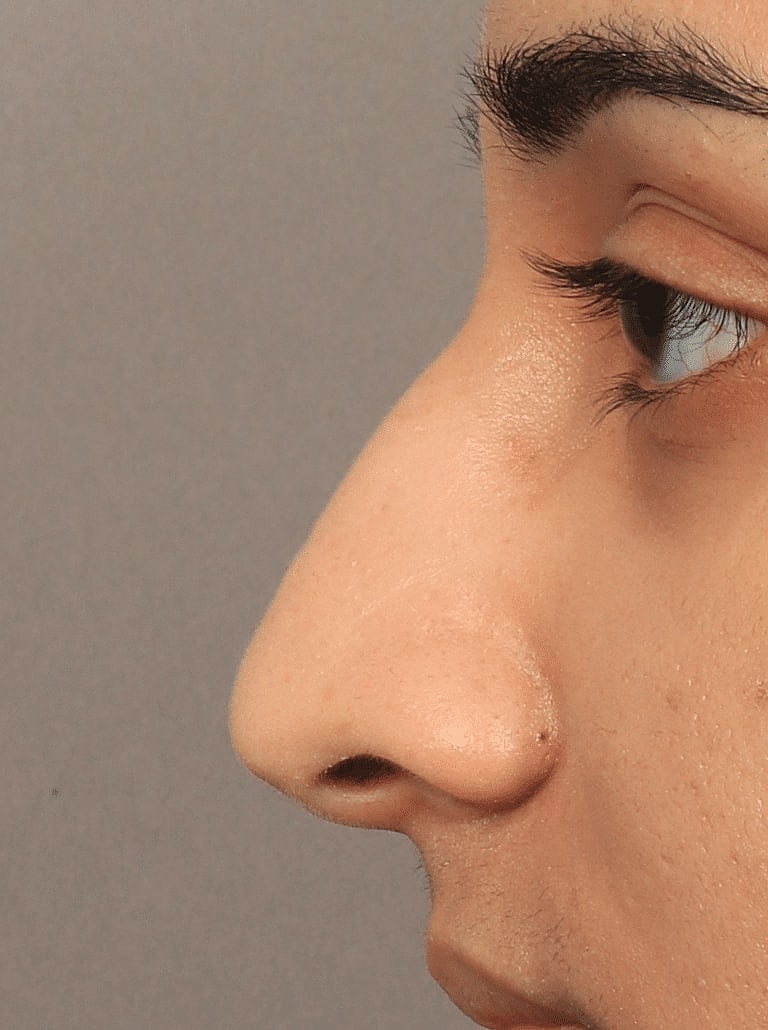 Alarplasty Nostril Reduction Before & After