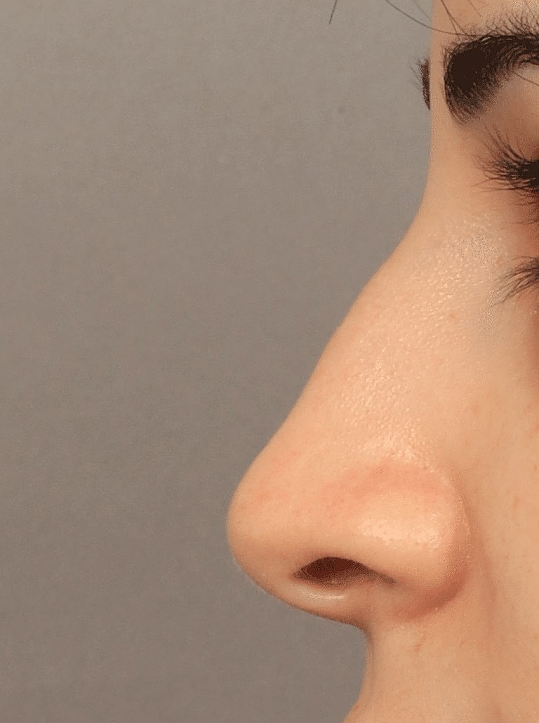 Alarplasty Nostril Reduction Before & After