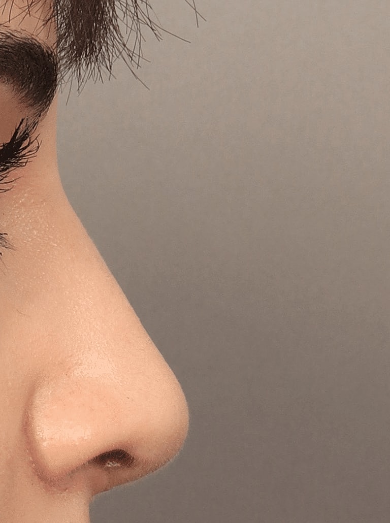 Alarplasty Nostril Reduction Before & After