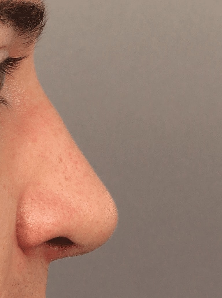 Alarplasty Nostril Reduction Before & After