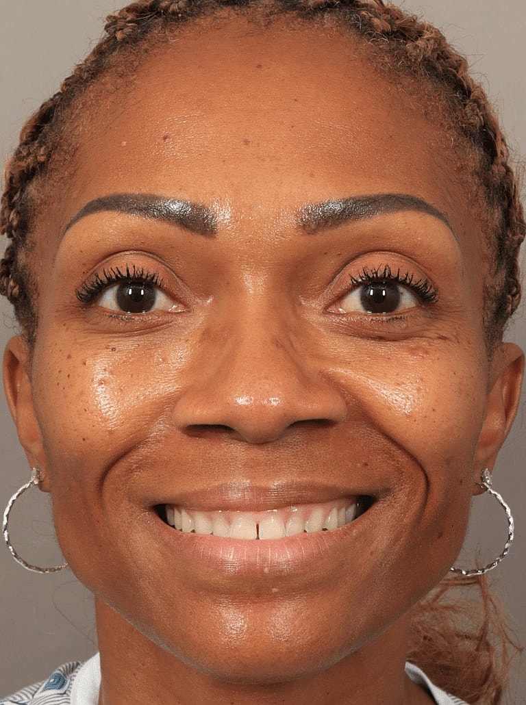 Alarplasty Nostril Reduction Before & After