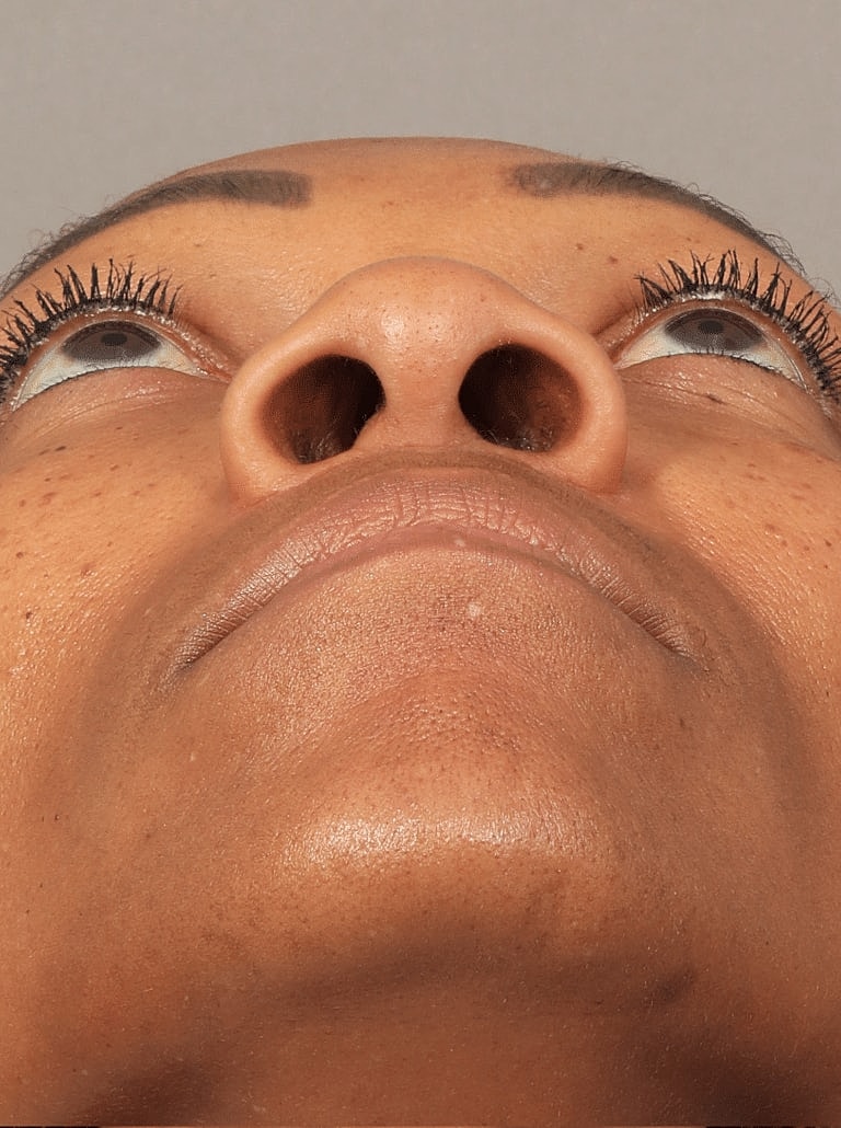 Alarplasty Nostril Reduction Before & After