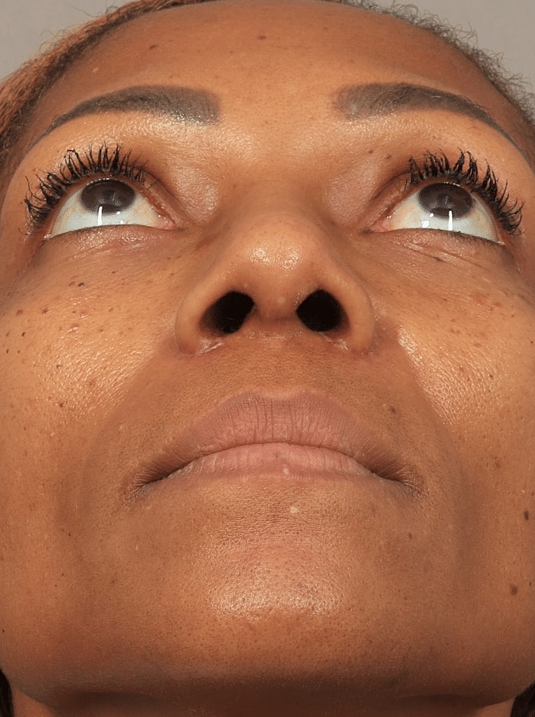 Alarplasty Nostril Reduction Before & After